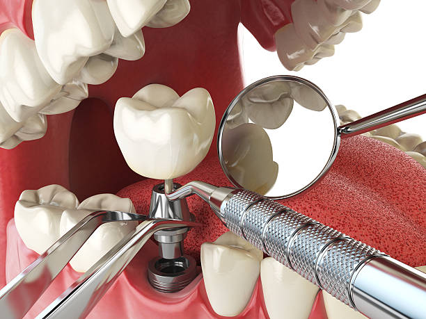 Best Emergency Dentist for Knocked-Out Tooth in Hildebran, NC
